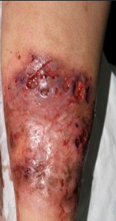 PYODERMA GANGRENOSUM