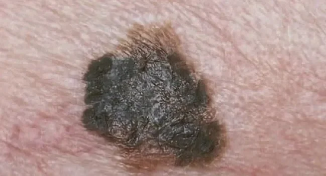 MELANOMA
