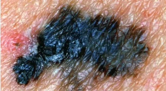 MELANOMA