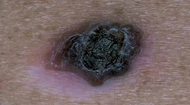 MELANOMA