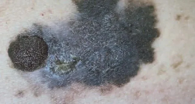MELANOMA
