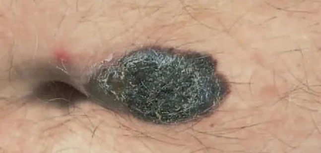 MELANOMA