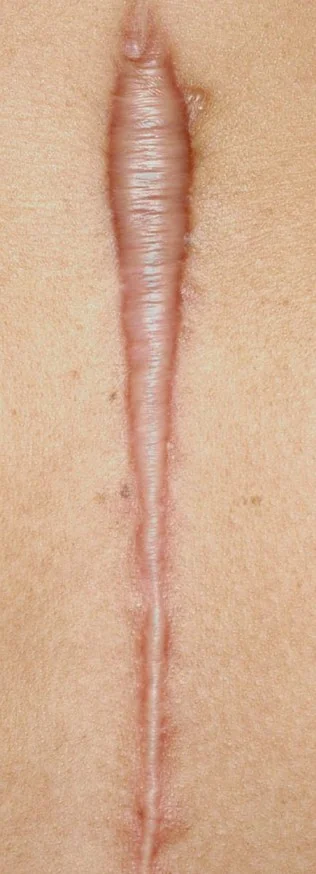 KELOID