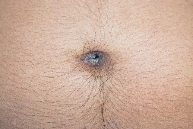 OMPHALITIS
