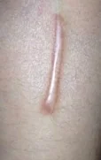 KELOID