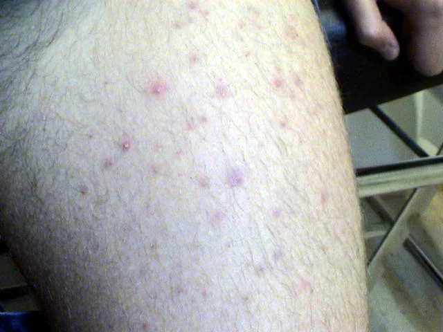 FOLLICULITIS
