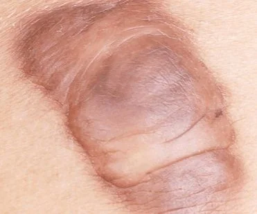 KELOID