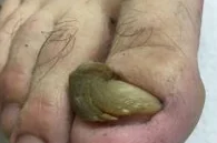 ONYCHOGRYPHOSIS