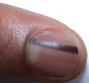 NAIL NEVUS