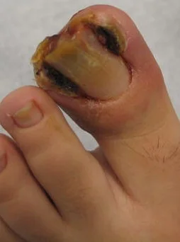 INGROWING TOENAIL