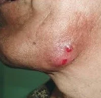ACTINOMYCOSIS