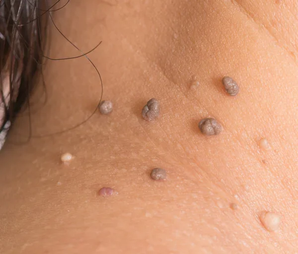 SKIN TAGS - ACROCHORDON