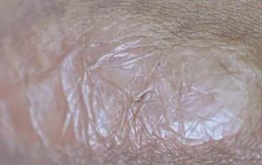 HYPERTROPHIC SCAR