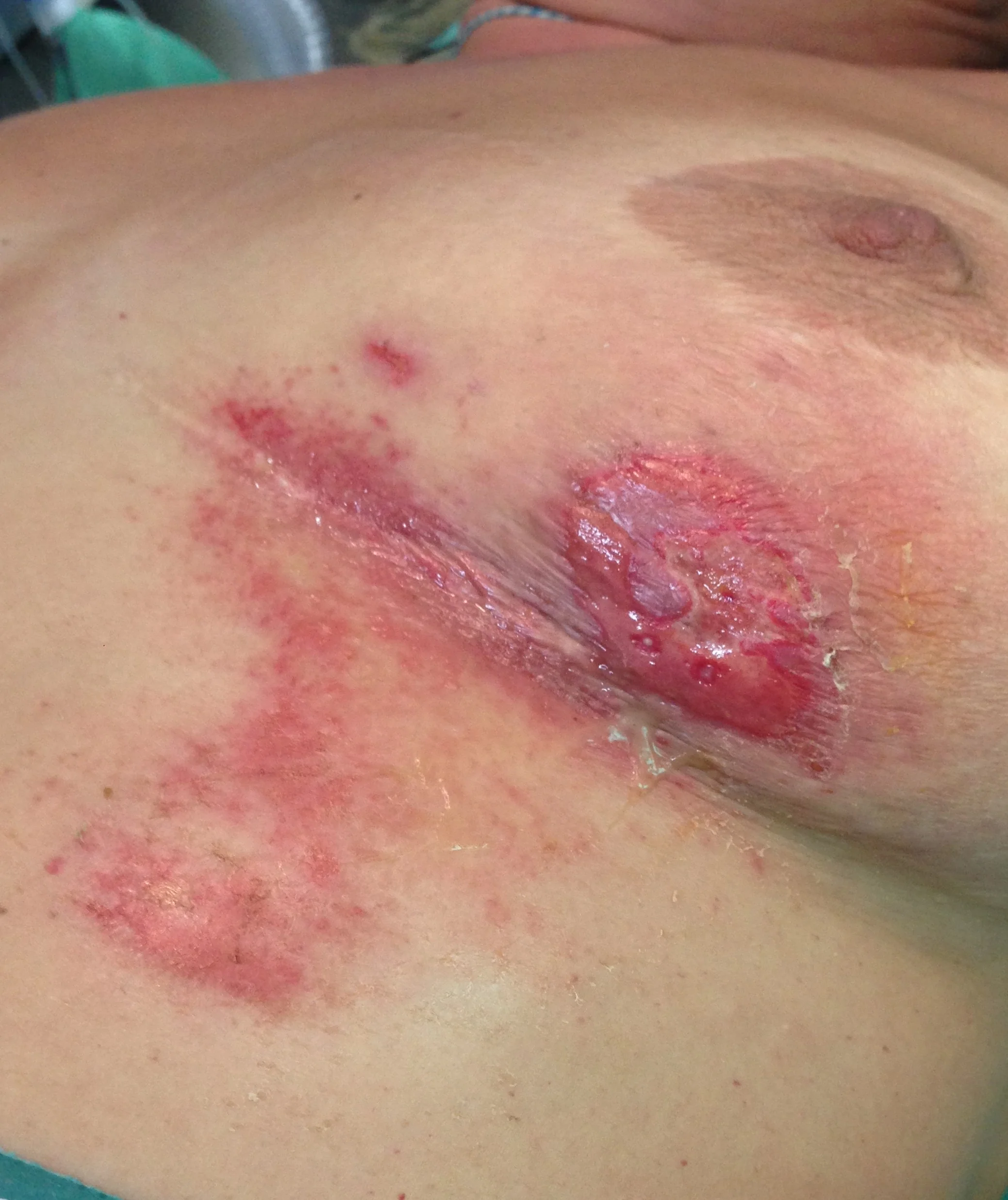 BREAST CELLULITIS