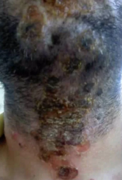 IMPETIGO