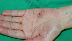 CUTANEOUS METASTASIS - GASTRIC CARCINOMA