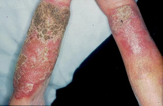 VEGETATIVE PYODERMATITIS