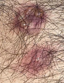 SUBCUTANEOUS METASTASIS