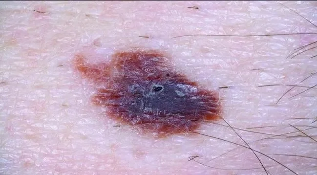 DYSPLASTIC NEVUS