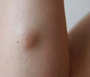 SEBACEOUS CYST