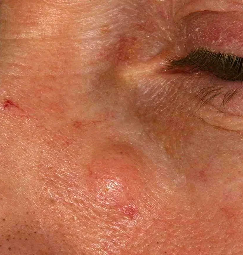 SEBACEOUS CYST