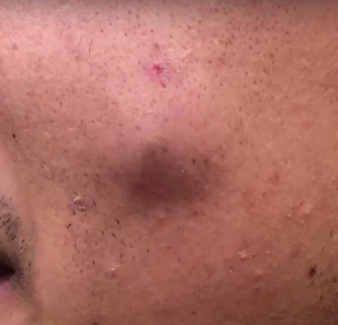 SEBACEOUS CYST