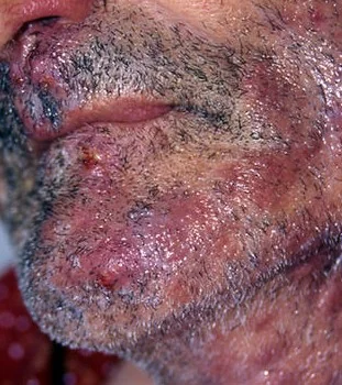 STAPHYLOCOCCAL SYCOSIS