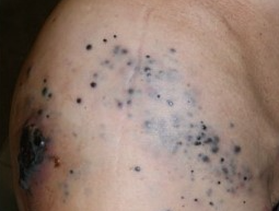 MELANOMA - IN TRANSIT METASTASES