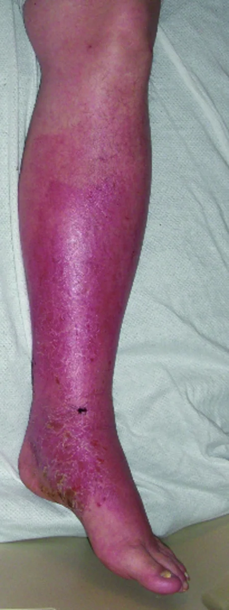 EOSINOPHILIC CELLULITIS