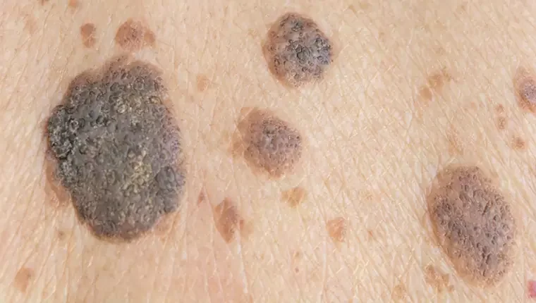 SEBORRHEICKERATOSIS