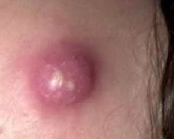 INFECTED SEBACEOUS CYST