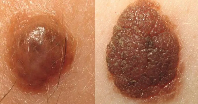 MIESCHER'S NEVI