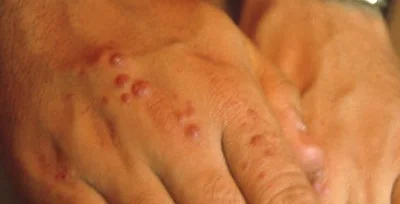 GRANULOMAS MYCOBACTERIUM MARINUM