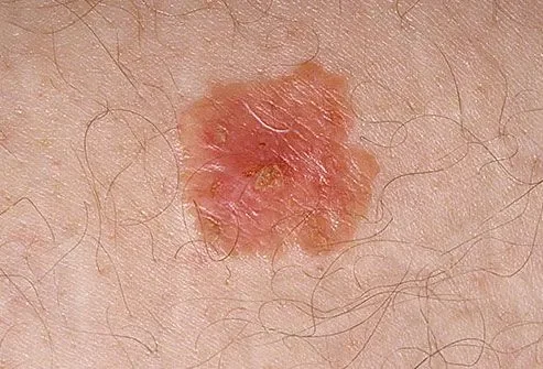 BOWEN DISEASE