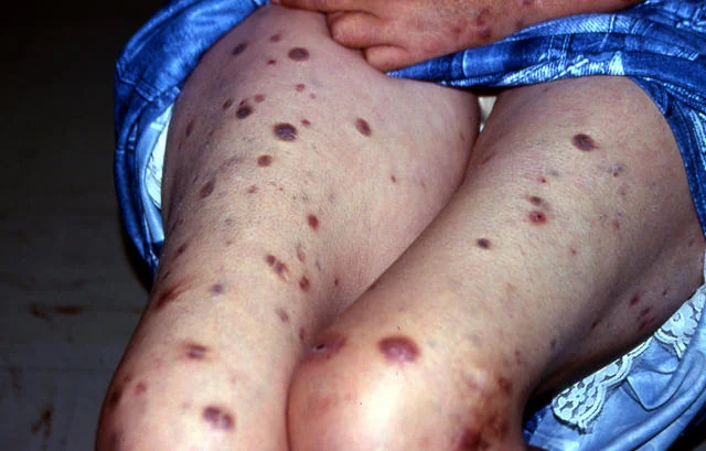HANSEN'S DISEASE