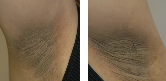 ACANTHOSIS NIGRICANS - OVARIAN CANCER