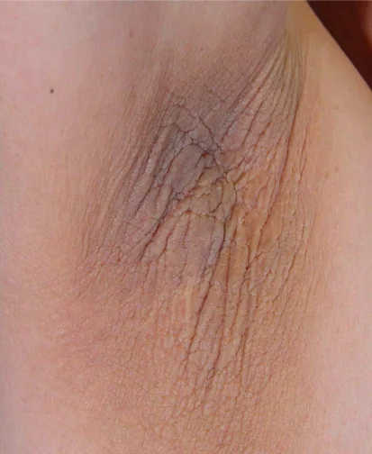 ACANTHOSIS NIGRICANS - OVARIAN CANCER
