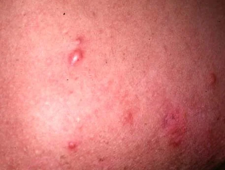 ACNE KELOIDALIS SCARS