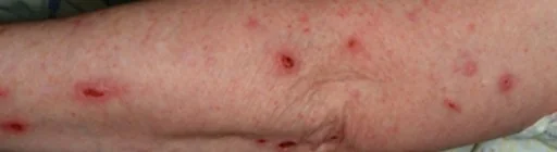 ACRODERMATITIS ENTEROPATHICA