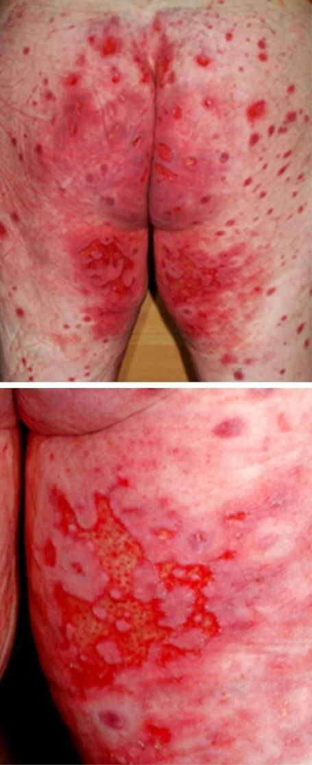 ACRODERMATITIS ENTEROPATHICA