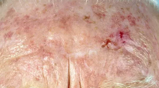 ACTINIC KERATOSIS