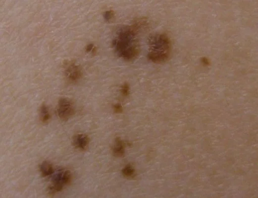 AGMINATED NEVUS