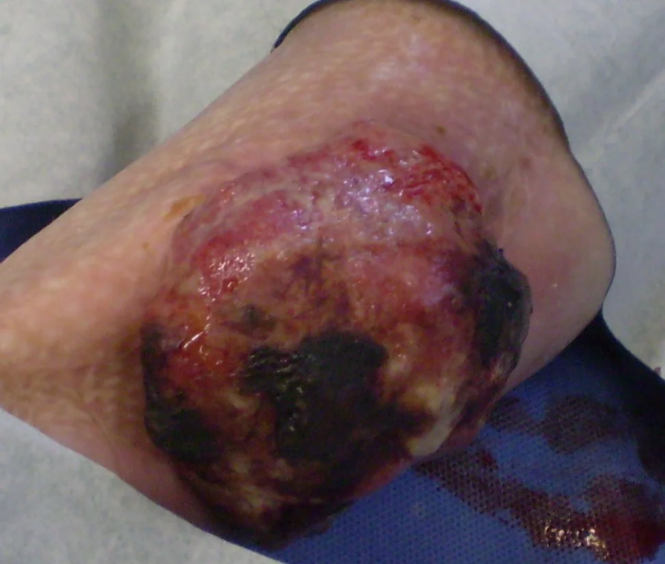 SQUAMOUS CELL CARCINOMA OF THE FOREARM