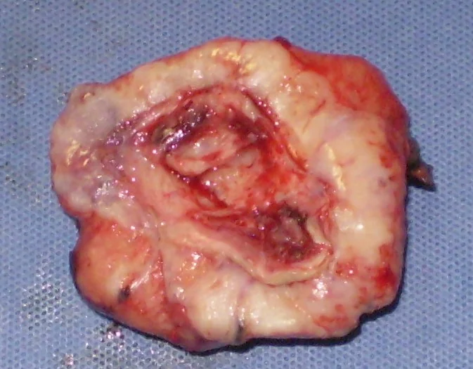 EXCISED SQUAMOUS CELL CARCINOMA OF THE FOREARM