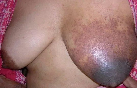 ALLERGIC DERMATITIS MIMICKING PAGET'S DISEASE