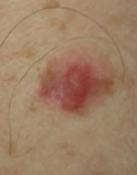 AMELANOTIC MELANOMA