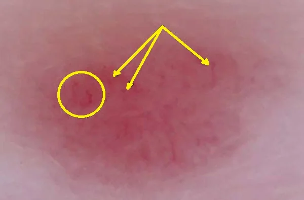 AMELANOTIC MELANOMA