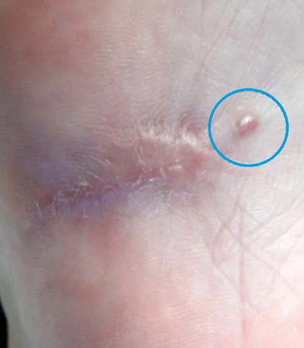 AMELANOTIC MELANOMA