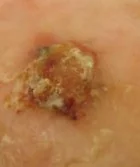 AMELANOTIC MELANOMA