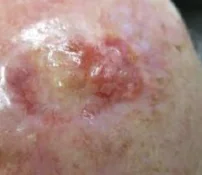 AMELANOTIC MELANOMA